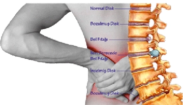 Bel Fıtığı Disk Kayması Belirtileri ve Tedavisi